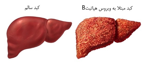 بیماری هپاتیک