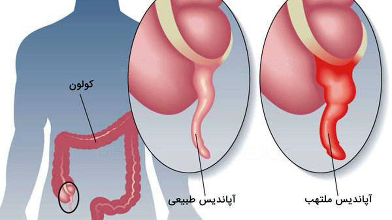 آپاندیس
