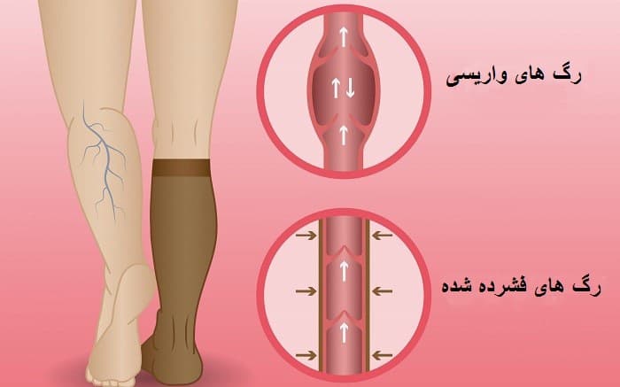 جوراب واریس