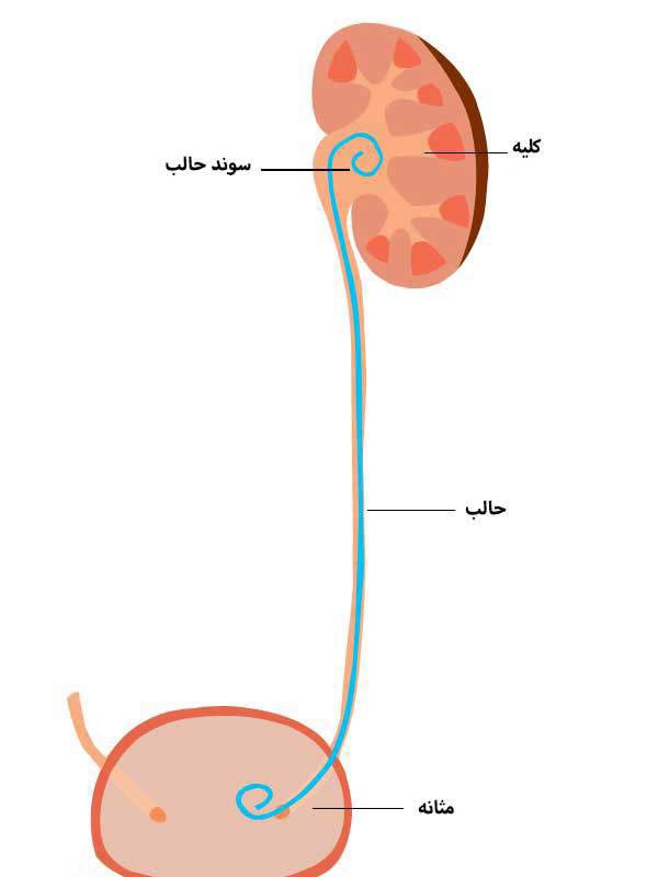 سوند حالب