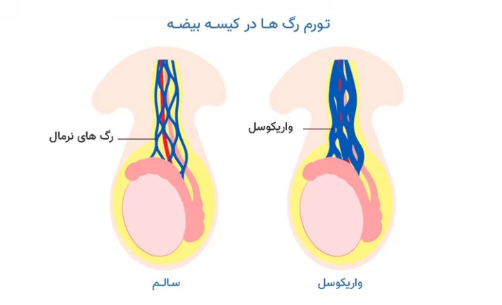 بیماری واریکوسل