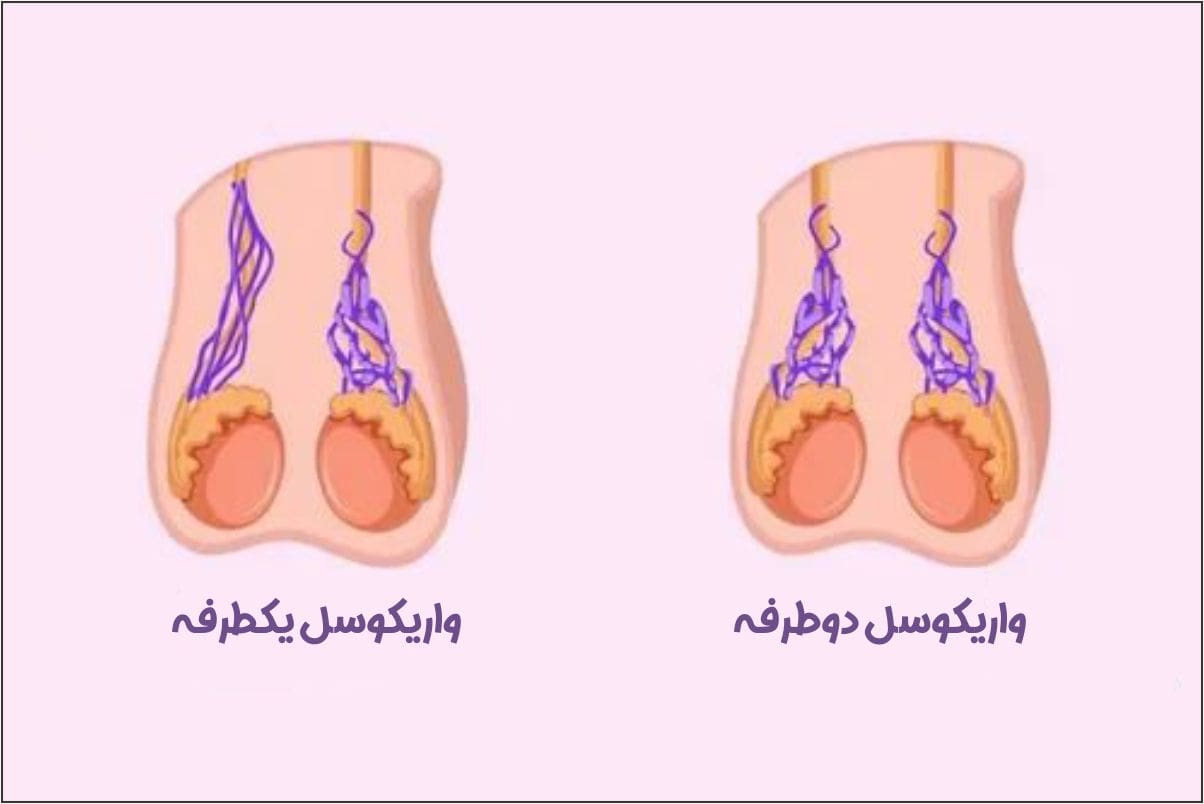 بیماری واریکوسل