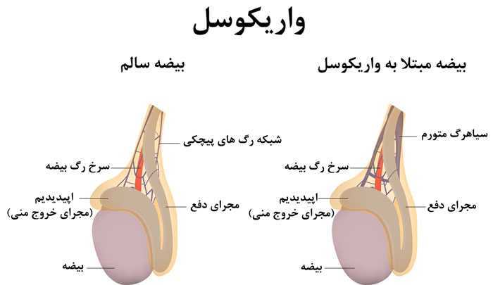 بیماری واریکوسل