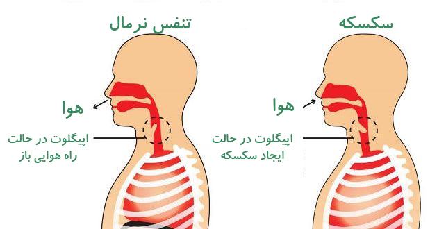 سکسکه