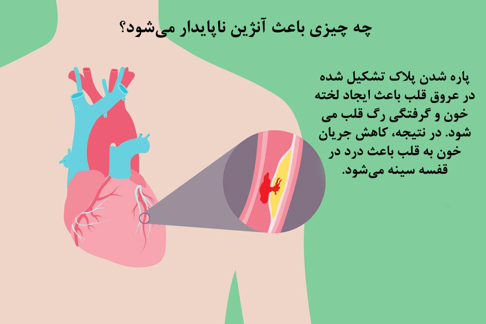 آنژین