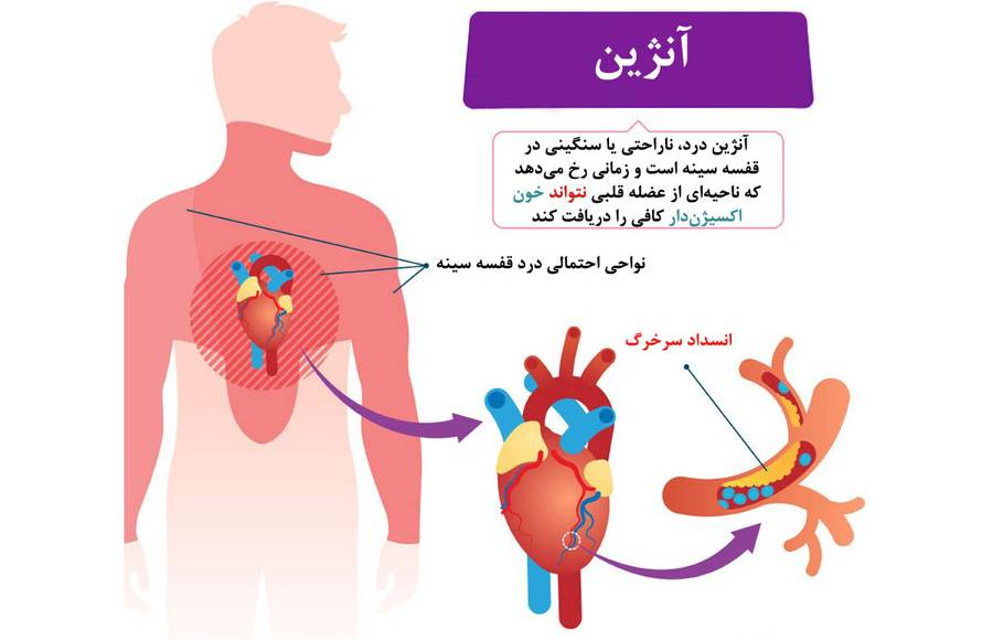 آنژین