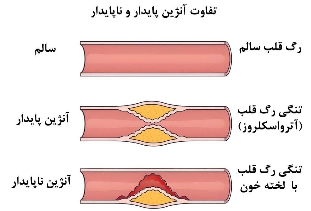 آنژین