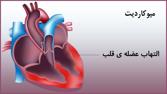 آنژین