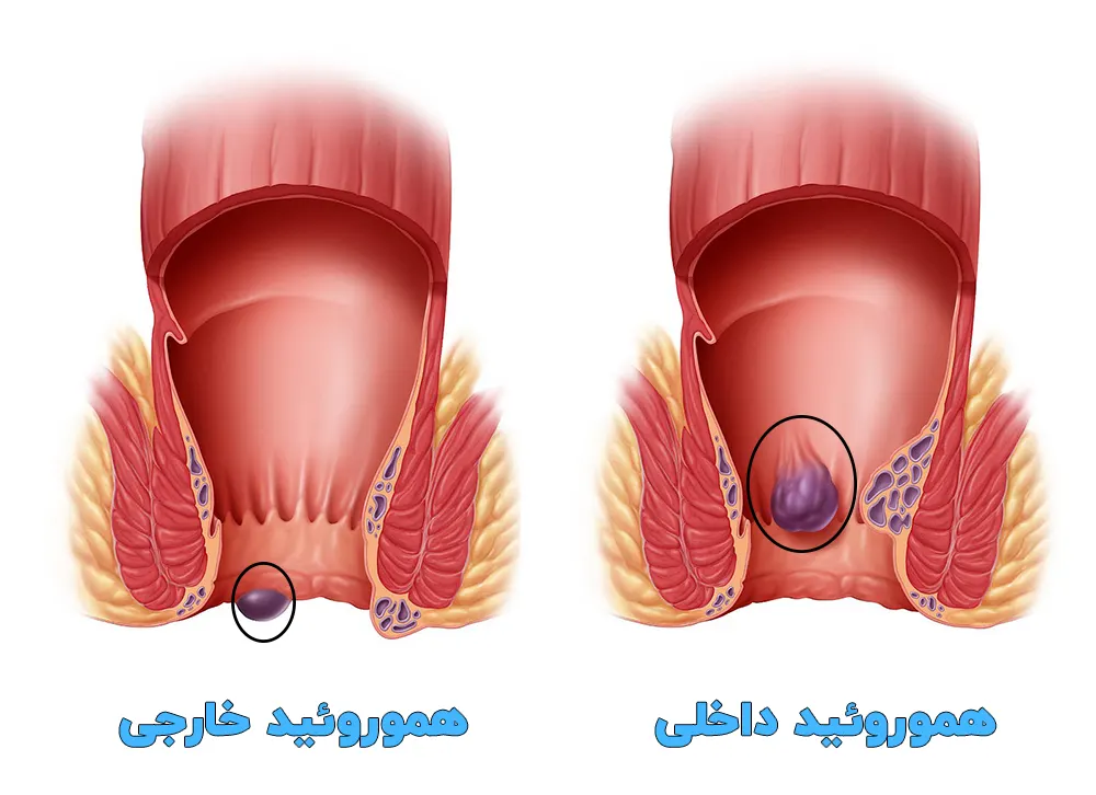 بواسیر