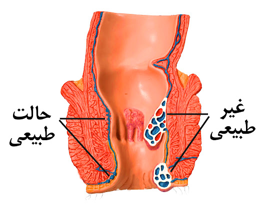 بواسیر