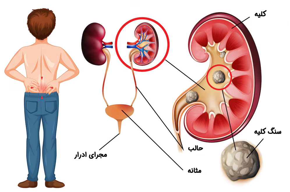 بیماری سنگ کلیه