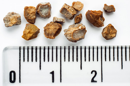 بیماری سنگ کلیه