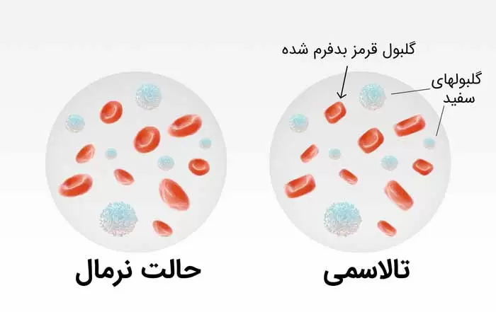 بیماری تالاسمی