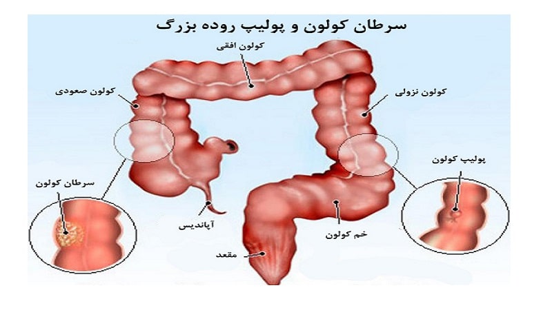 سرطان کولون