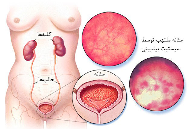 عفونت مثانه