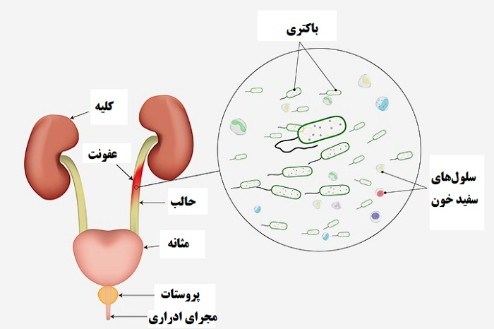 عفونت مثانه