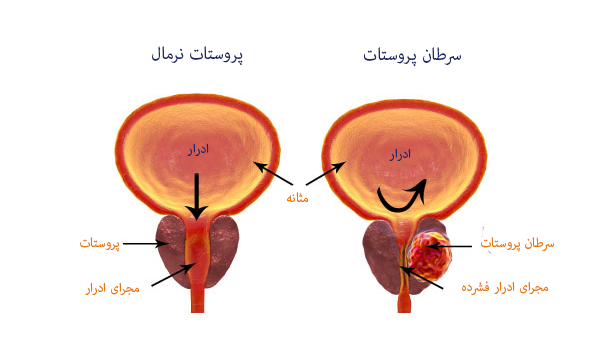 سرطان پروستات