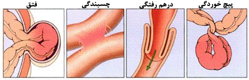 چسبندگی یا انسداد روده