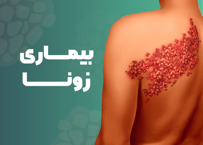 بیماری زونا یا هرپس زوستر