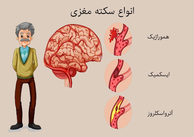 سکته مغزی