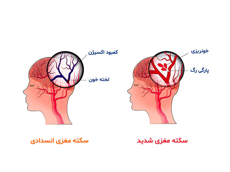 سکته مغزی