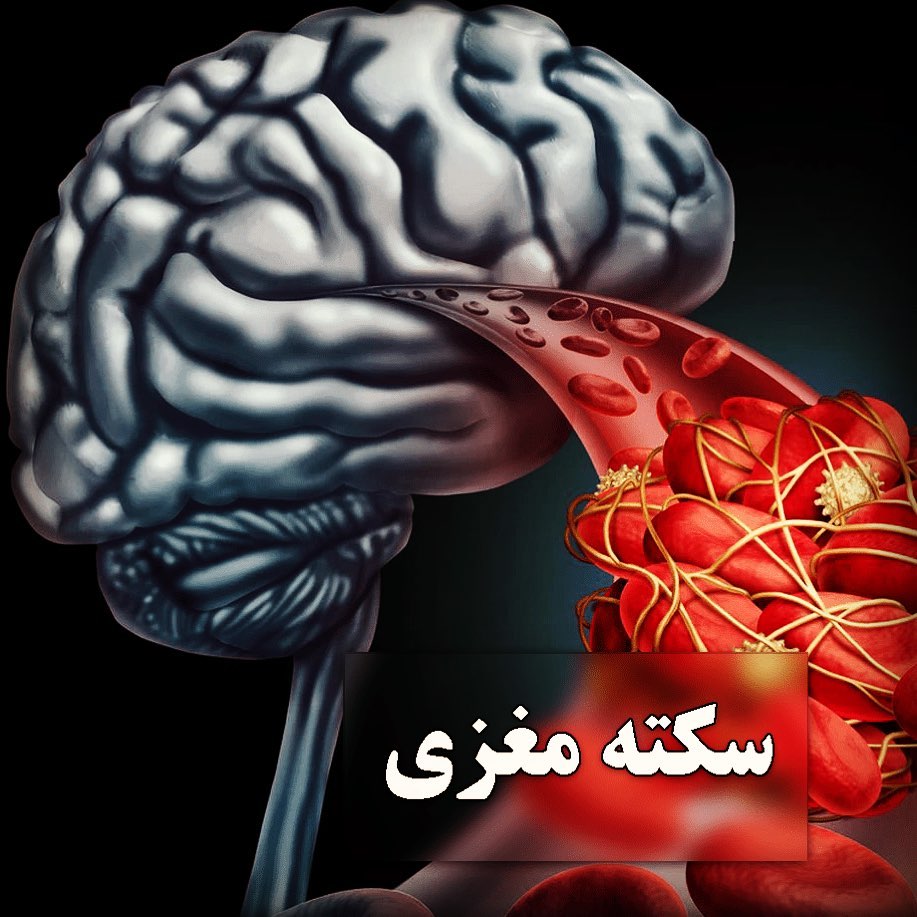 ساختار مغز و سکته مغزی