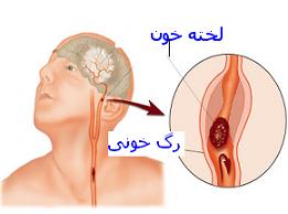 سکته مغزی