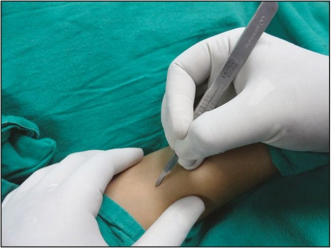 تفاوت بین ابزار جراحی استیل ضدزنگ و تیتانیوم &ndash; کدام بهتر است؟