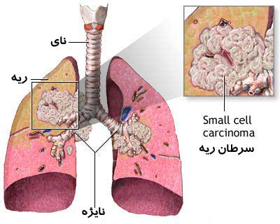 سرطان چیست