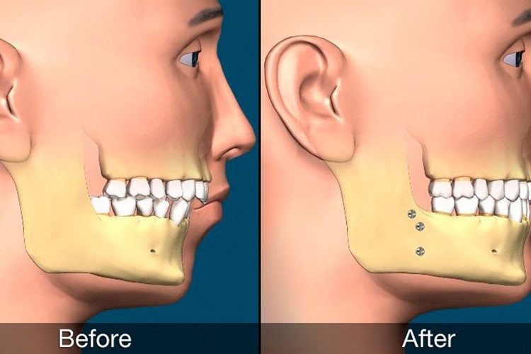 جراحی فک و صورت چیست؟ ابزار های مورد نیاز برای جراحی فک و صورت