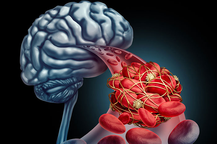 بیماری سکته مغزی چیست؟