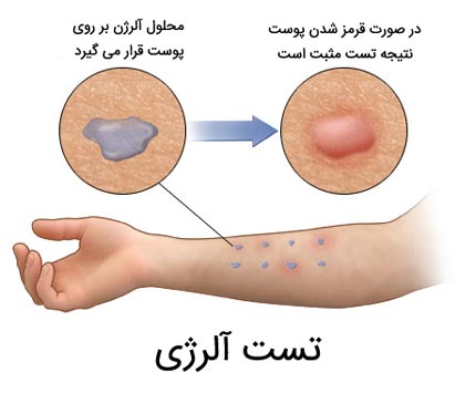 آلرژی چیست؟