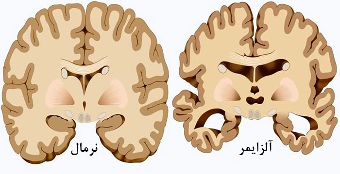بیماری آلزایمر چیست؟