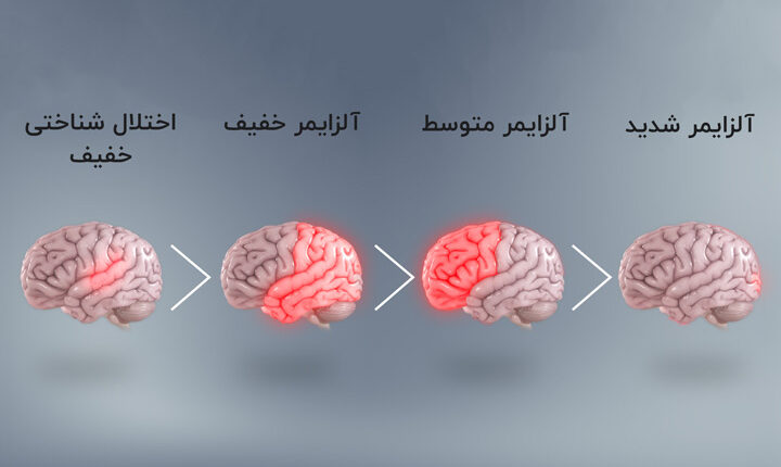 بیماری آلزایمر چیست؟