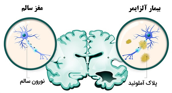 بیماری آلزایمر چیست؟
