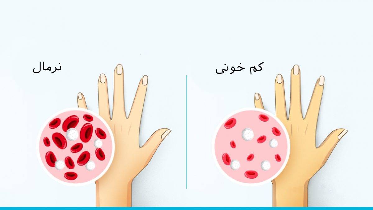 فقر آهن یا کم خونی