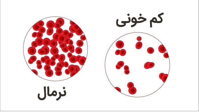 فقر آهن یا کم خونی