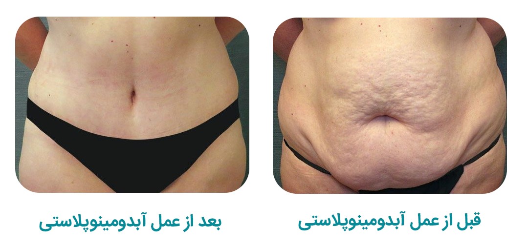 عمل ابدومینوپلاستی