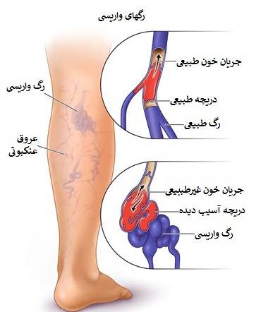 بیماری واریس