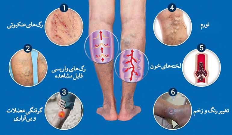 بیماری واریس