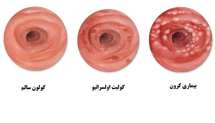 بیماری کورن روده