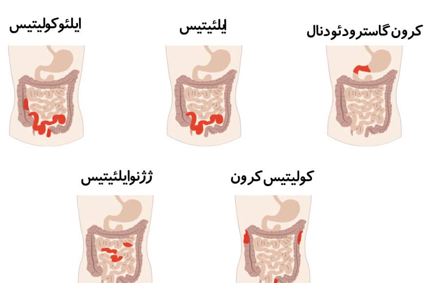 بیماری کورن روده