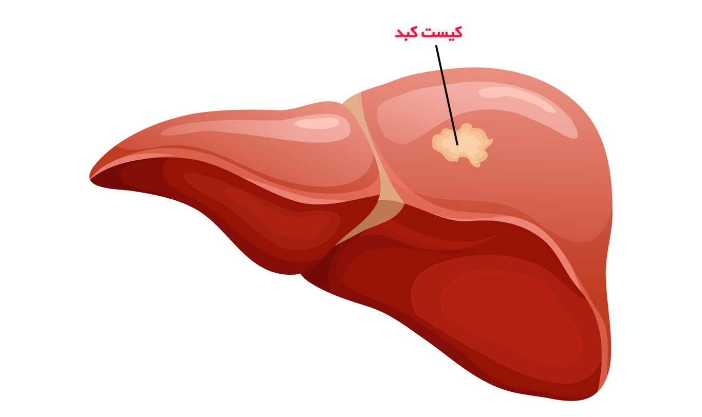 انواع کیست