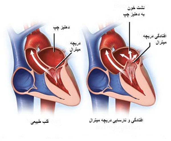 دریچه میترال