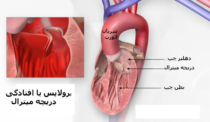 دریچه میترال