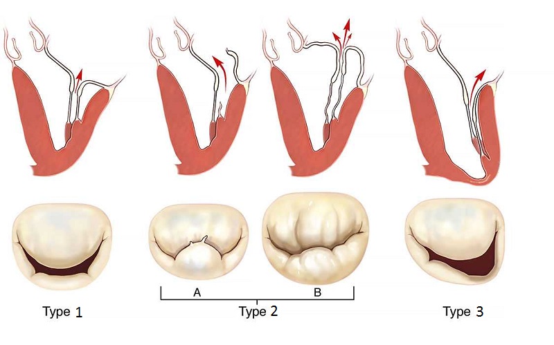 دریچه میترال