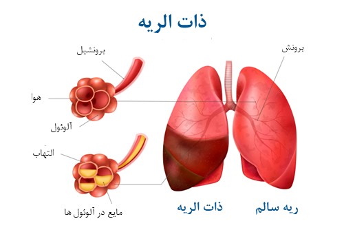 ذات الریه